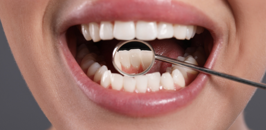 dental Plaque Buildup