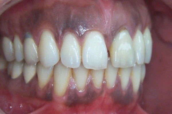 carcinogens found in smokeless tobacco Oral Cancer Perhaps Results from Chemical Found In Smokeless Tobacco carcinogens found in smokeless tobacco Oral Cancer Perhaps Results from Chemical Found In Smokeless Tobacco