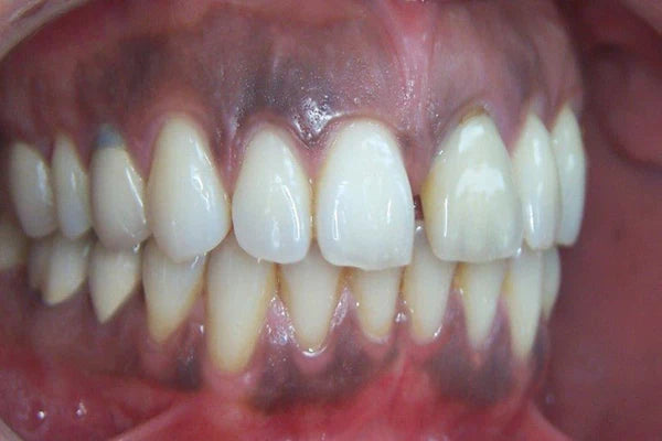 How to get rid of black gum disease?