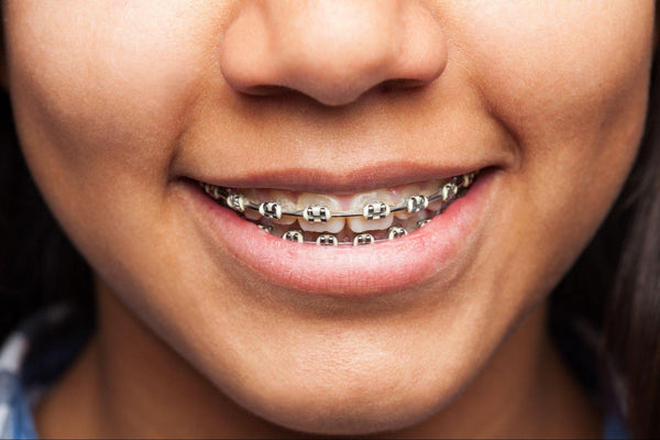 Smiling with Confidence: How Oral Hygiene Boosts Your Orthodontic Success