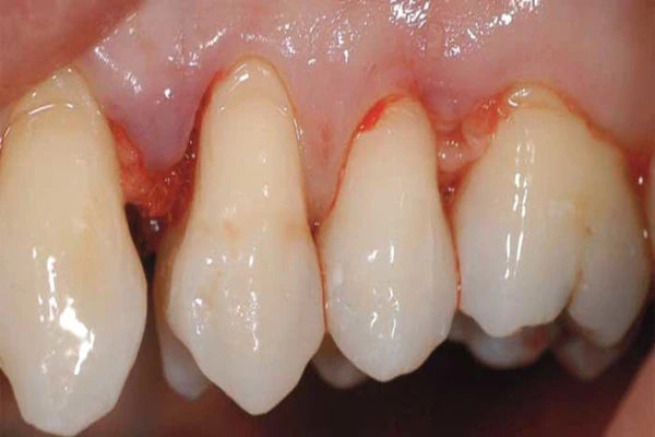 The periodontal pocket