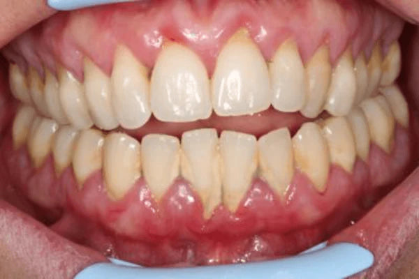 How to treat chronic periodontitis?