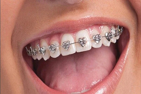 Braces: advantages and disadvantages