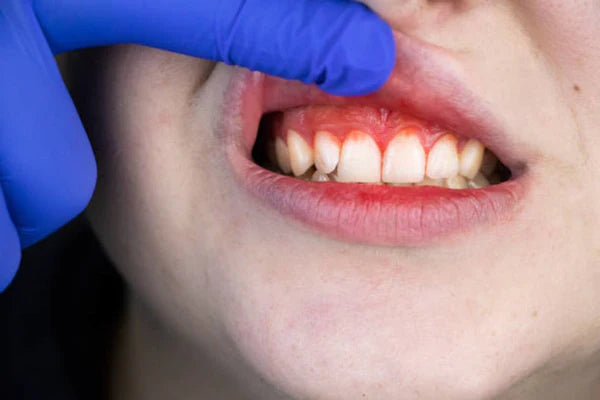 Inflammatory gums: How to get better?