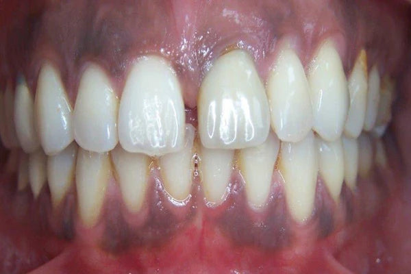 All about dark gums