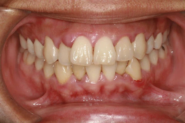 Which antibiotic for gingivitis?