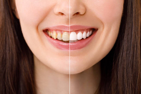 Smile Brighter: The Secrets of Teeth Whitening Revealed