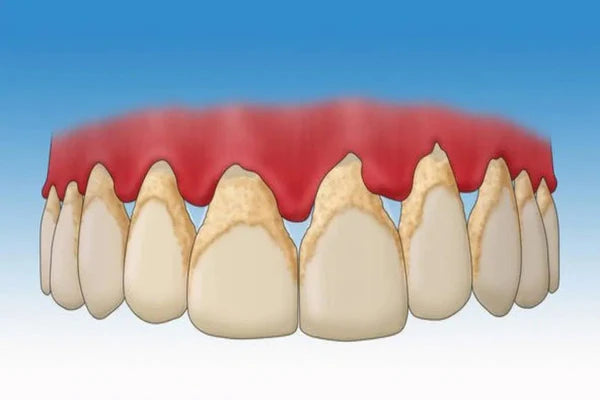 Dental plaque: What is it?