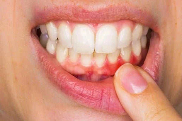 What are the symptoms of gingivitis ?